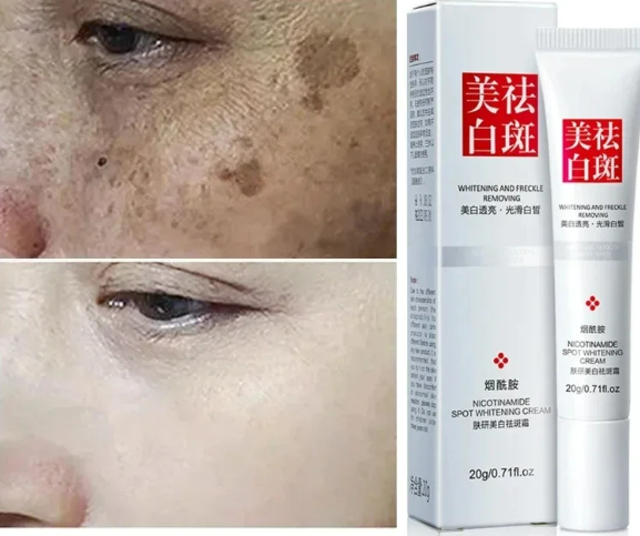 Effective Whiten Freckle Cream Brighten Face Remove Dark Face Spot